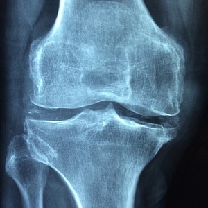 Arthrose
